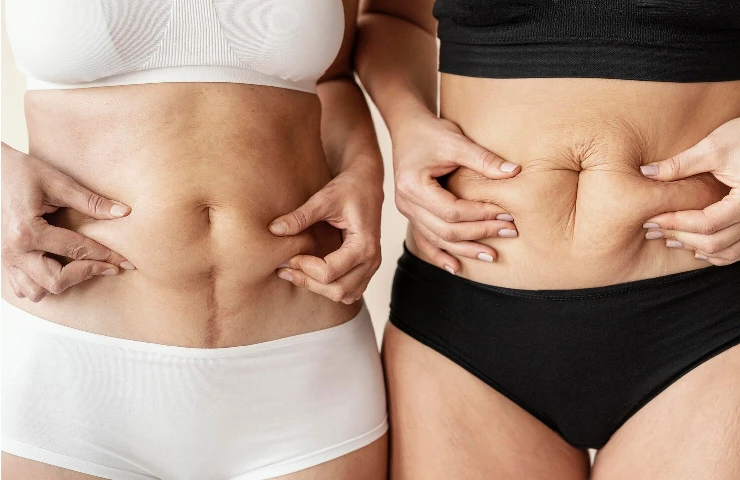 Laser Liposuction vs Traditional Liposuction: What's the Difference?