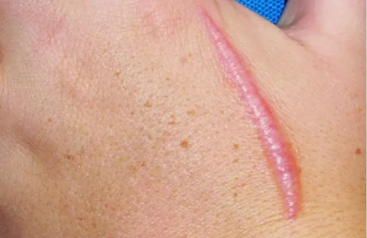 Keloid Scars and Best Ways to Treat Them