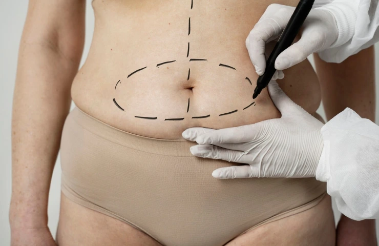Complete Guide to Abdominoplasty Surgery: Procedure, Benefits, and Recovery