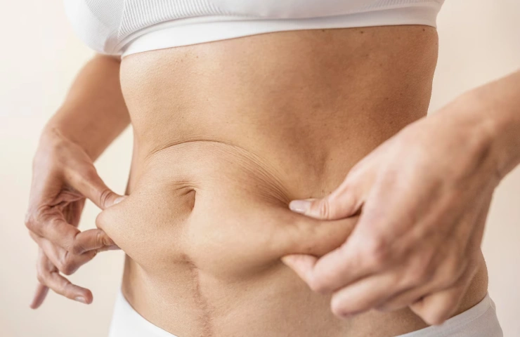 Liposuction Vs. Tummy Tuck: Which One Is Right for You?