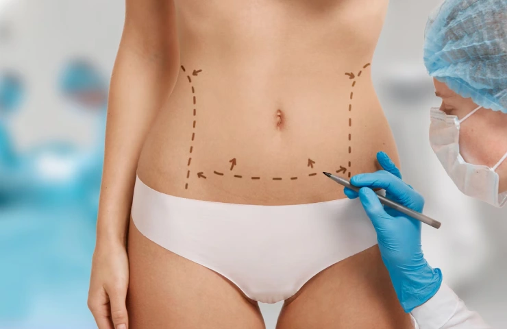 What Is Fat Grafting? The Complete Guide to Fat Transfer Surgery