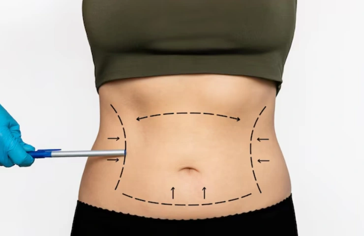 Liposuction 360 Vs Traditional Liposuction: Which Is Better?