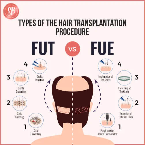 SB Aesthetics is known for providing the best hair transplant in Delhi by the best hair transplant surgeons. Consult with Dr. Shilpi Bhadani for the hair transplant cost in delhi.