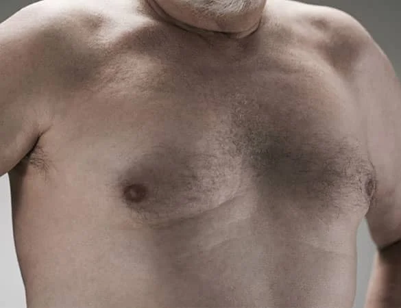 Gynecomastia