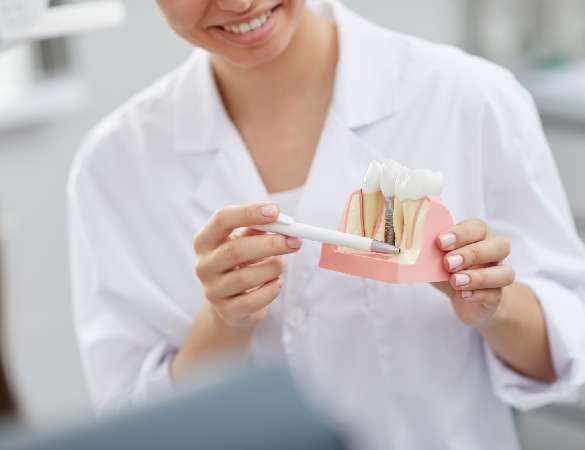Immediate Dental Implants