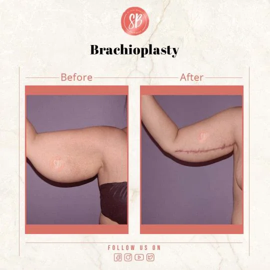 Brachioplasty