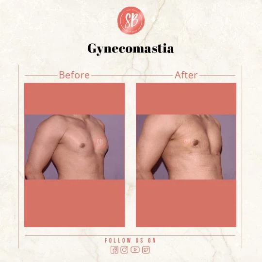 gynecomastia before and after