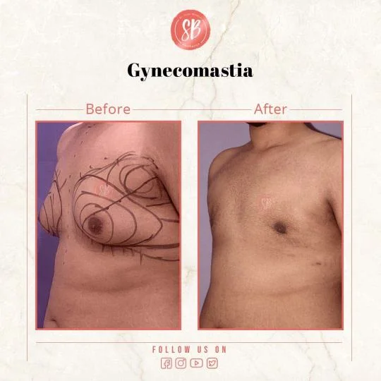 gynecomastia surgery before and after