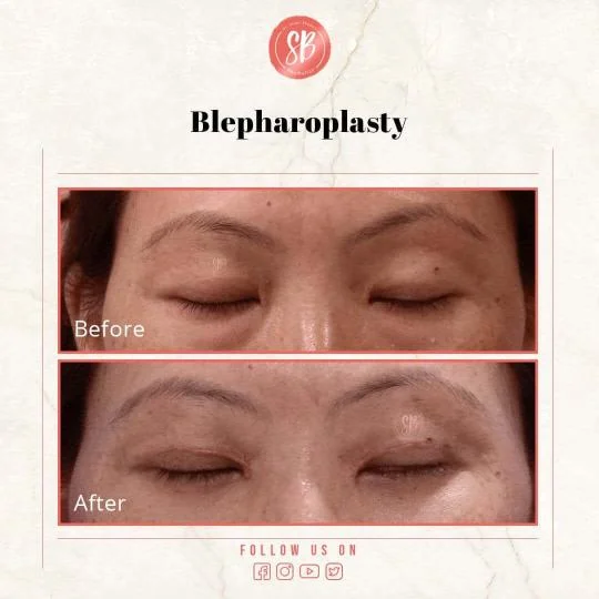 blepharoplasty before and after