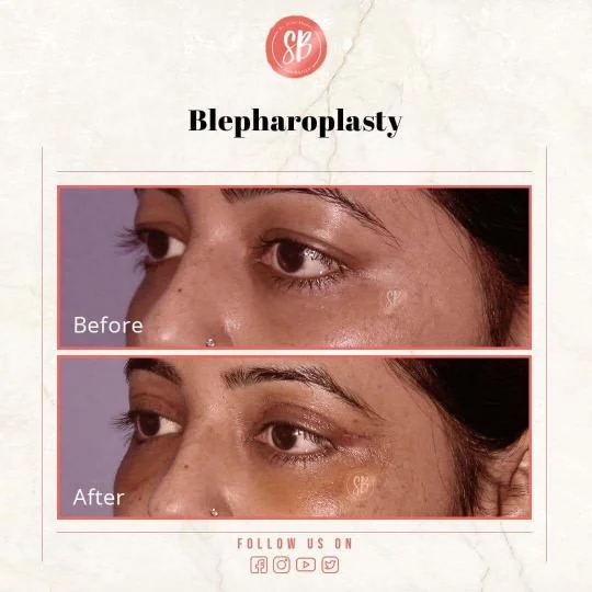 blepharoplasty before and after pictures