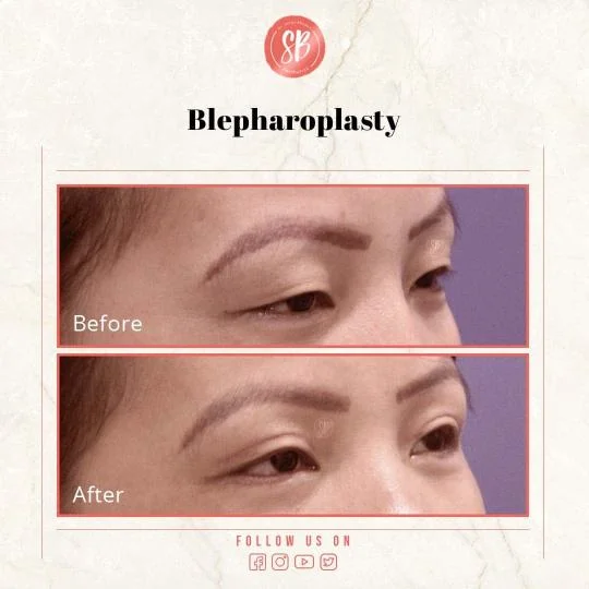 blepharoplasty before and after photos