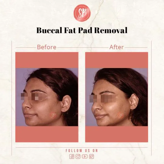 Buccal Fat Pad Removal