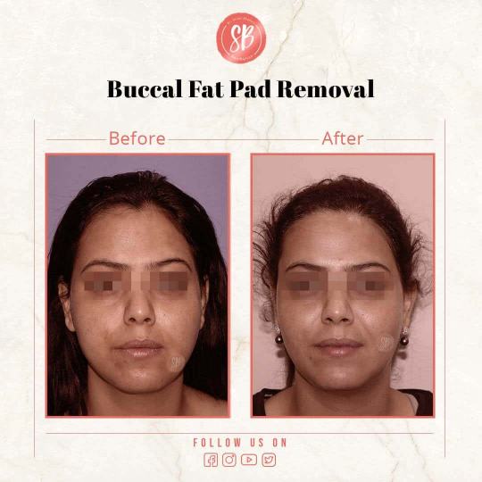 Buccal fat pad removal – Before and After Pictures *