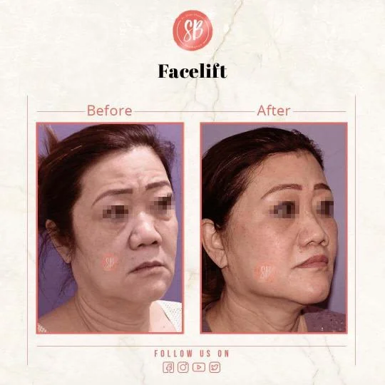 Facelift