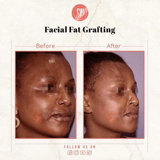 Facial Fat Grafting