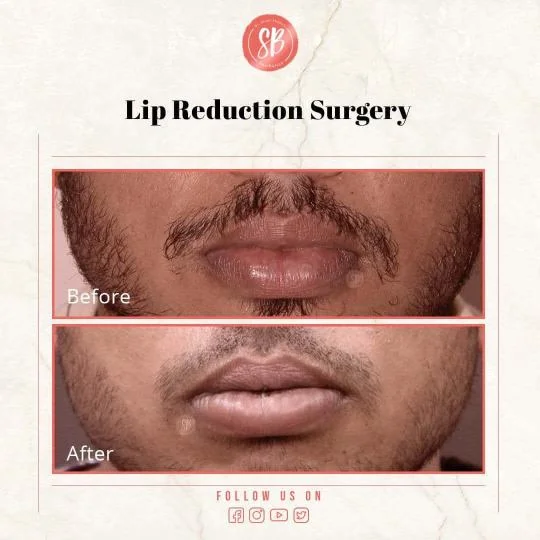 Lip Reduction Surgery