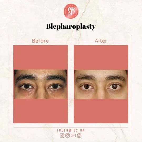 Blepharoplasty