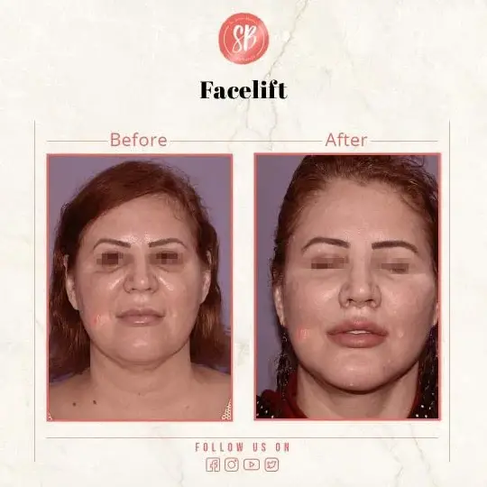 Facelift