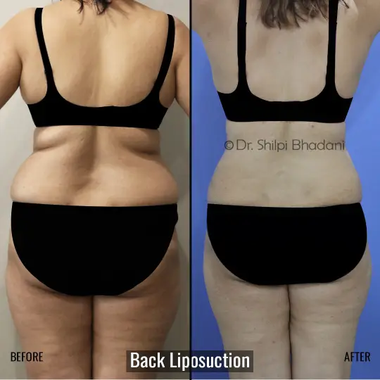 Back Liposuction