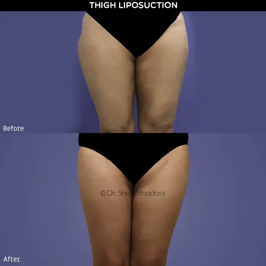 Thigh Liposuction