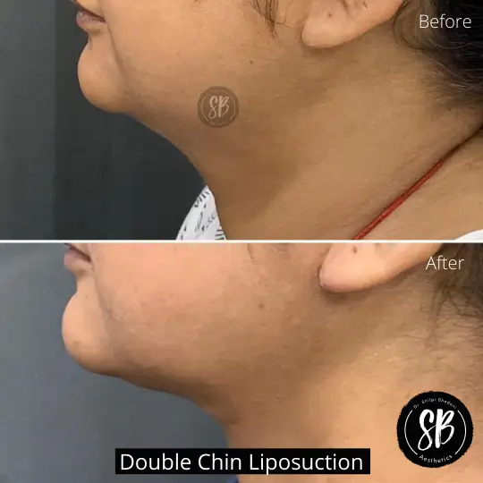 Double chin Liposuction