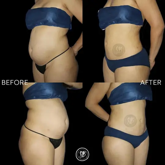 Side Arms and Abdominal Liposuction