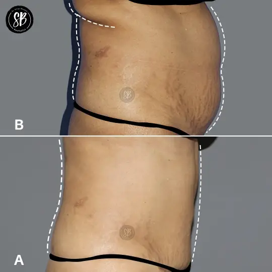 Liposuction