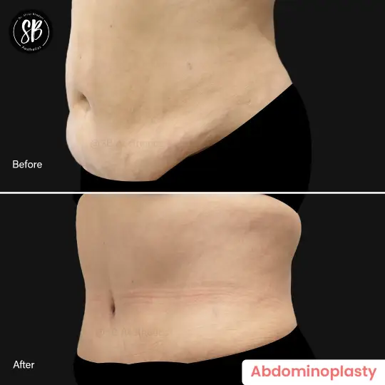 Abdominoplasty