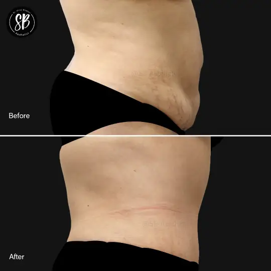 Abdominoplasty