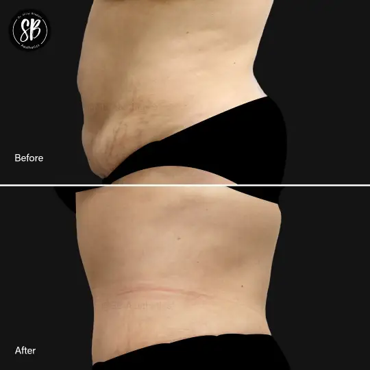 Abdominoplasty