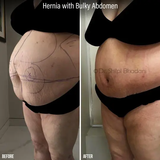 Abdominoplasty