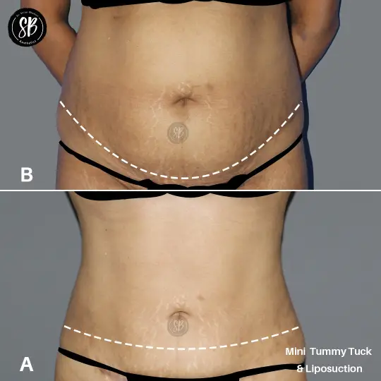 Abdominoplasty