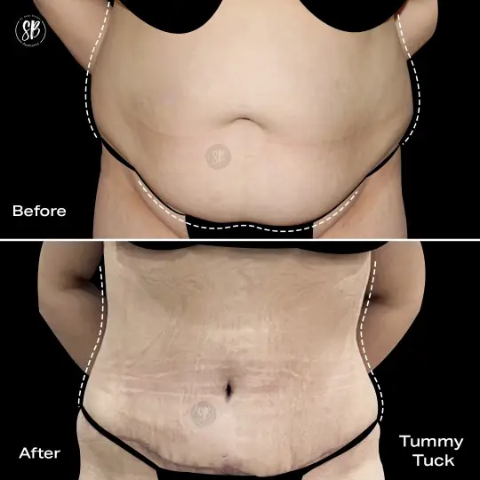 Abdominoplasty