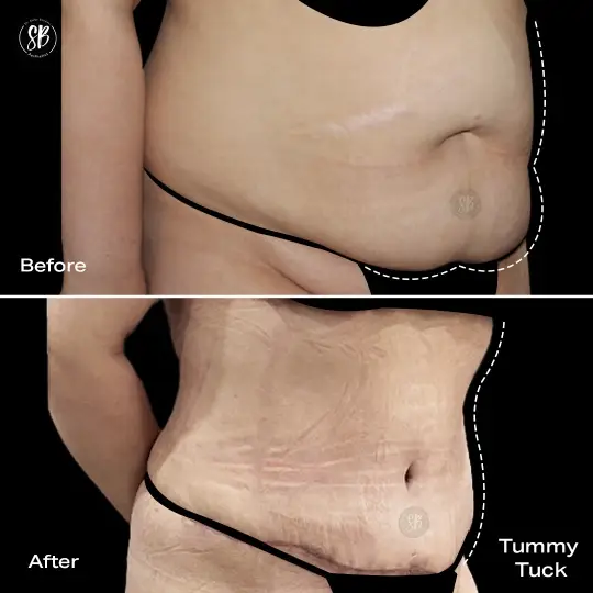 Abdominoplasty