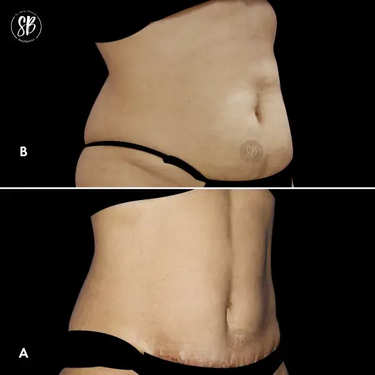 Abdominoplasty