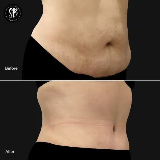 Abdominoplasty