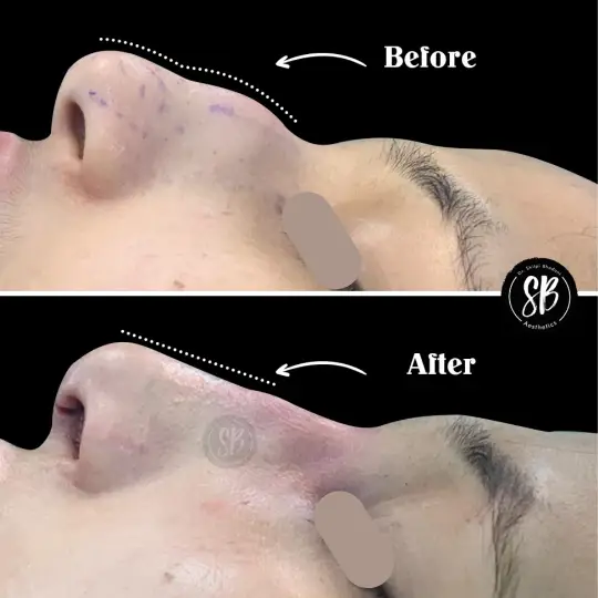 Rhinoplasty