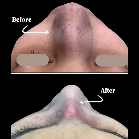 Rhinoplasty