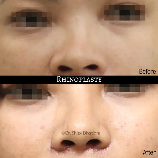 Rhinoplasty