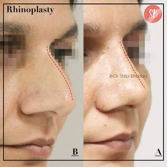 Rhinoplasty