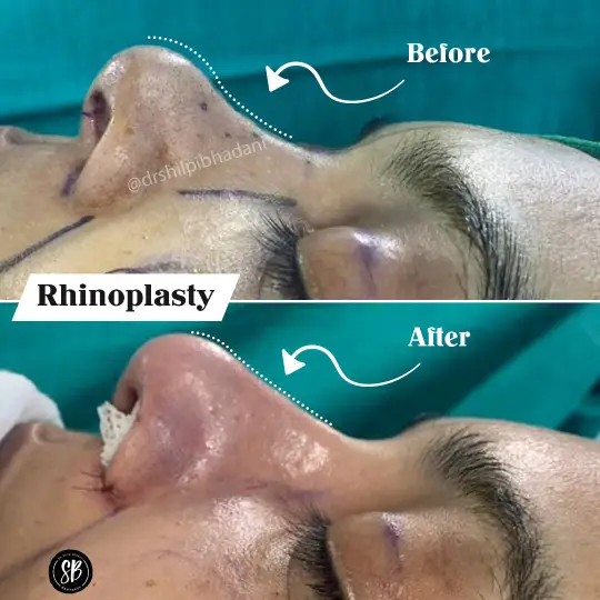 Rhinoplasty