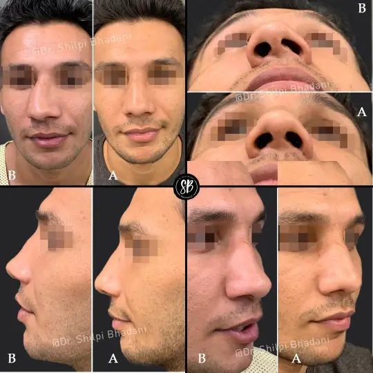 Rhinoplasty