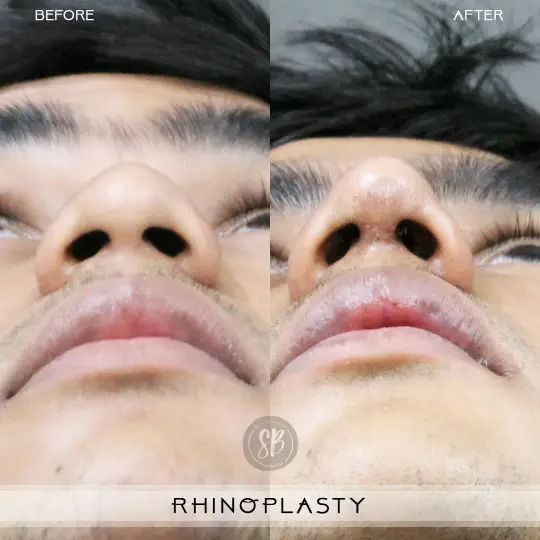 Rhinoplasty