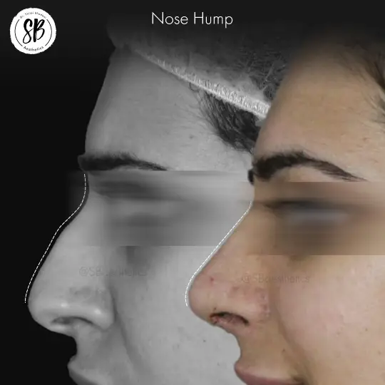 Rhinoplasty