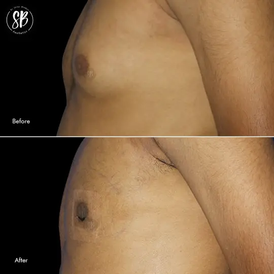 before after gynecomastia