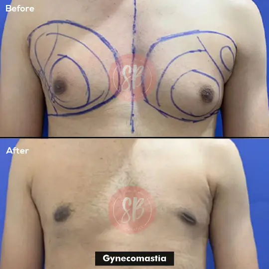 Gynecomastia