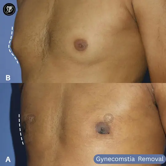 Gynecomastia