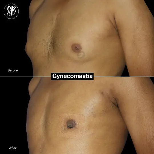 Gynecomastia