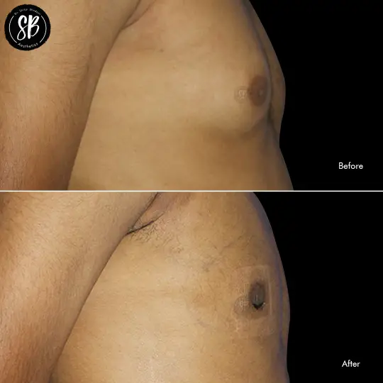 Gynecomastia