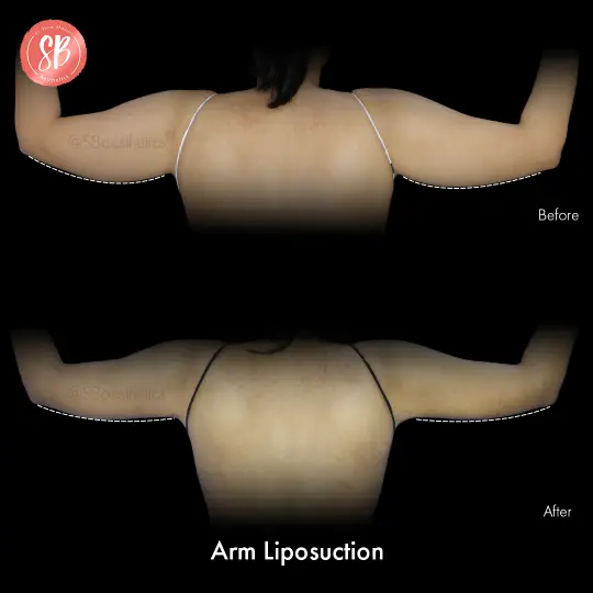 Liposuction